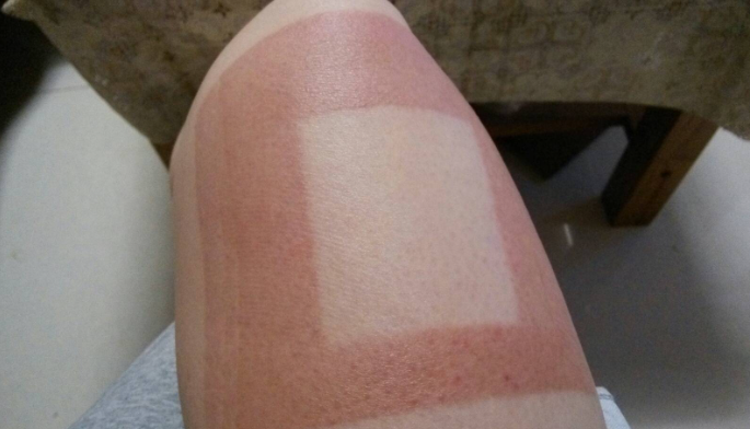 貼膏藥過敏怎么辦-修康藥業 貼膏藥過敏怎么辦-修康藥業